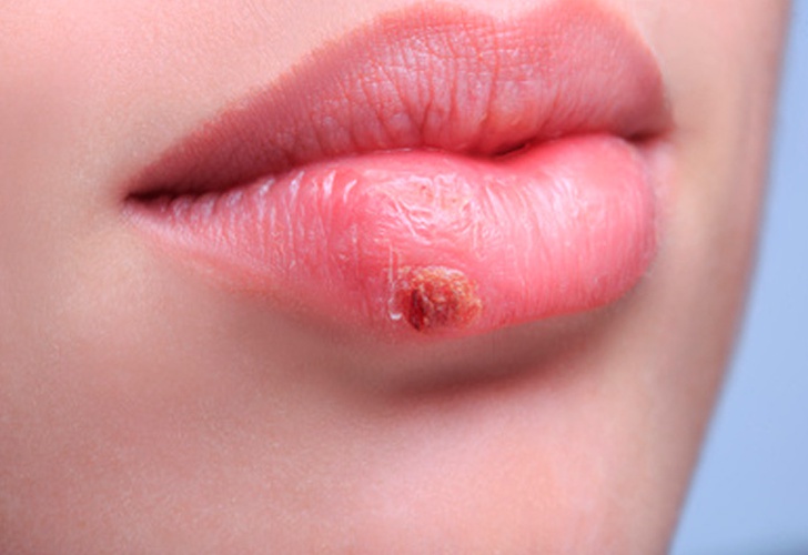 Herpes Labial Todo Lo Que Debes Saber Mujer